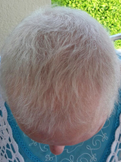 Haarausfall nach Chemo und 2 Monaten Behandlung mit Thymuskin / Hair loss after chemo and 2 months with Thymuskin
