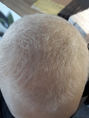 Haarausfall nach Chemo und 6 Wochen Behandlung mit Thymuskin / Hair loss after chemo and 6 weeks with Thymuskin