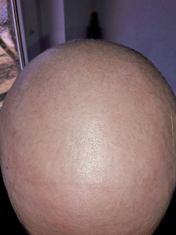 Haarausfall in Folge einer Chemotherapie / Hair loss through chemotherapy