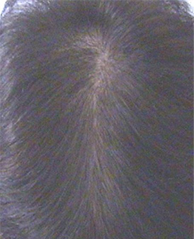 Erblich bedingter Haarausfall nach der Behandlung mit Thymuskin / Hereditary hair loss after treatment with Thymuskin