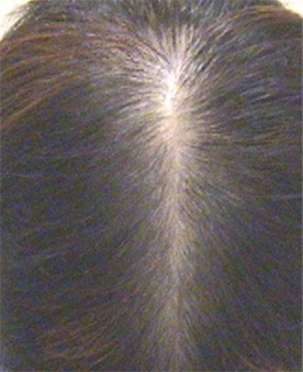 Erblich bedingter Haarausfall / Hereditary hair loss