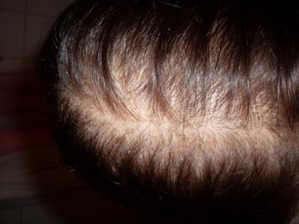 Erblich bedingter Haarausfall / Hereditary hair loss