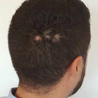 Circular hair loss (Alopecia Areata) | THYMUSKIN®