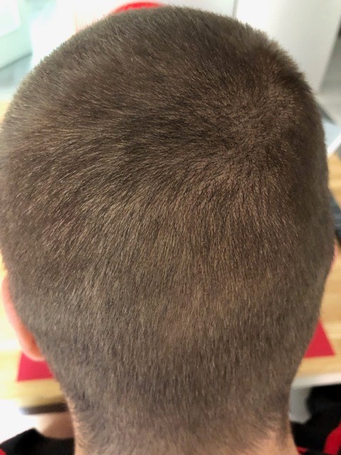 Diffuse hair loss (Alopecia Diffusa) | THYMUSKIN® Diffuse hair loss (Alopecia Diffusa) | THYMUSKIN®