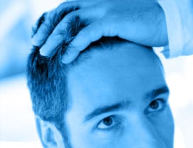 Erblich bedingter Haarausfall / Hereditary hair loss