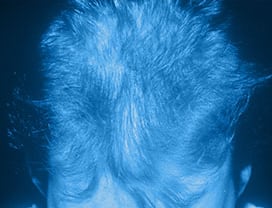 Haarausfall durch Stress / Hair loss through stress
