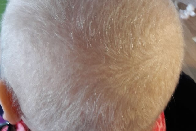 Haarausfall Frau Chemotherapie / Hair loss woman chemotherapy