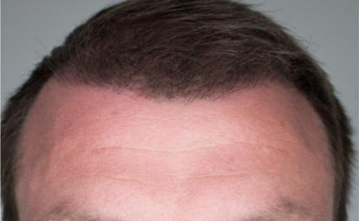 Haarwachstum nach Haartransplantation