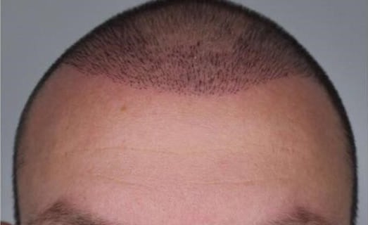 Haarwachstum nach Haartransplantation