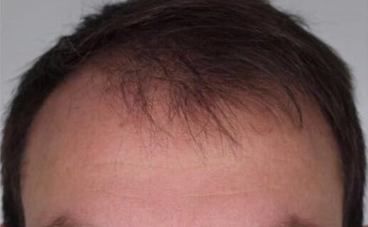 Haarausfall vor Haartransplantation
