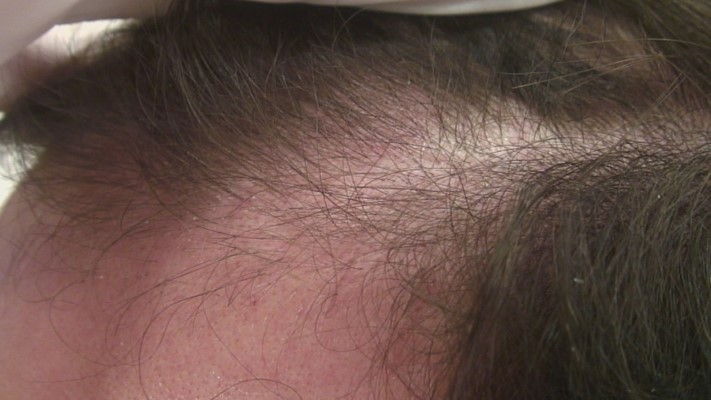 Hereditary Hair Loss Before / Erblich bedingter Haarausfall vorher