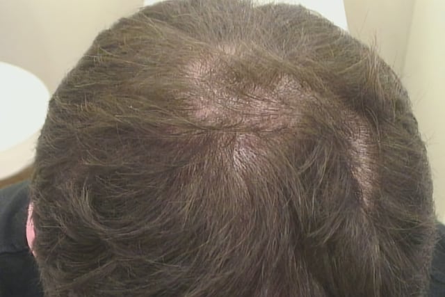 Erblich bedingter Haarausfall / Hereditary Hair Loss