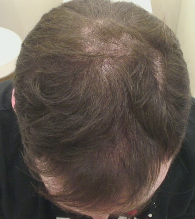 Genetic Hair Loss Treatment  Svenson