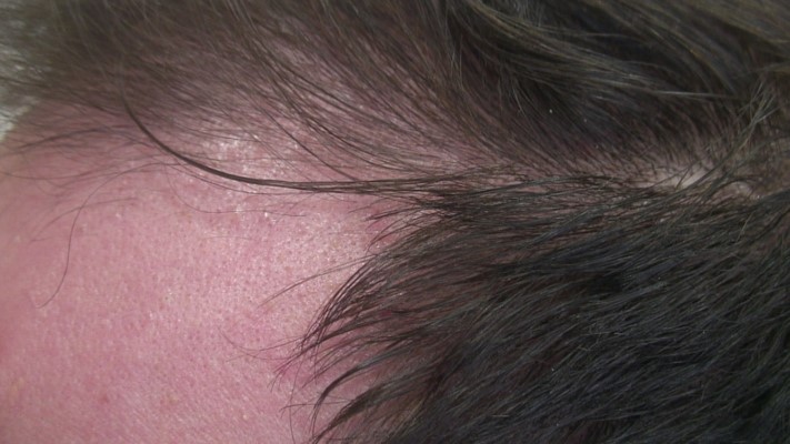 Hereditary Hair Loss After / Erblich bedingter Haarausfall nachher