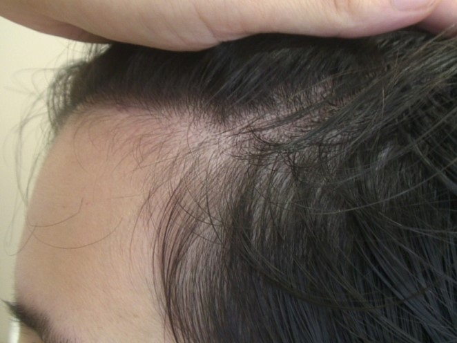 Hereditary Hair Loss Before / Erblich bedingter Haarausfall vorher