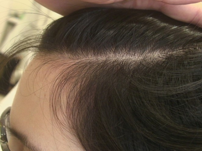 Hereditary Hair Loss After / Erblich bedingter Haarausfall nachher