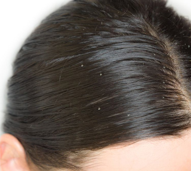 Schuppen / Dandruff